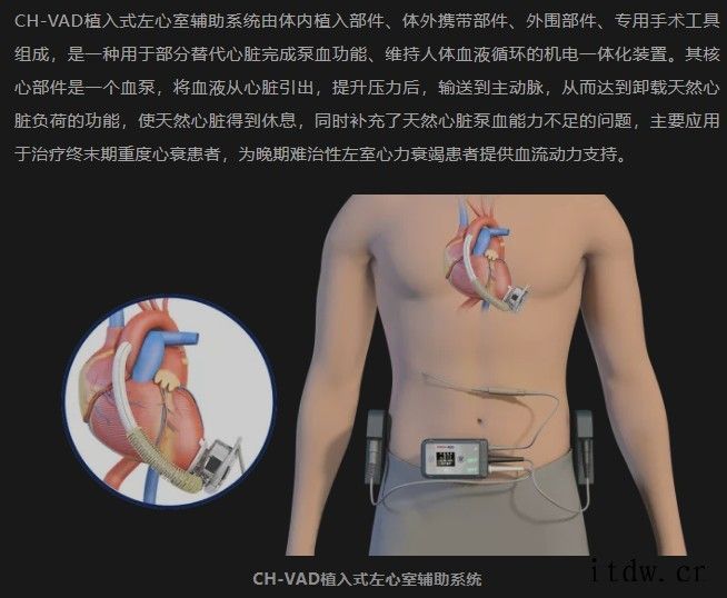 全球范围内首个获得 NMPA 批准、国内首款全磁悬浮式人工心