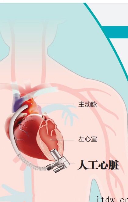 全球最小“人工心脏”在华中科大完成植入,58岁患者术后精神状