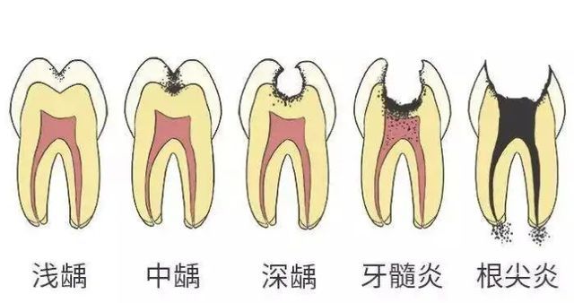 做了牙齿手术后过了一周可以吃糖了吗的简单介绍