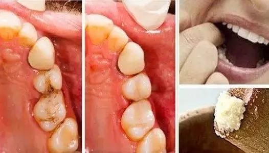 做了牙齿手术后过了一周可以吃糖了吗的简单介绍