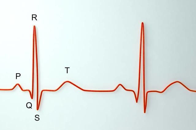 窦性心律什么意思(心电图窦性心律什么意思)