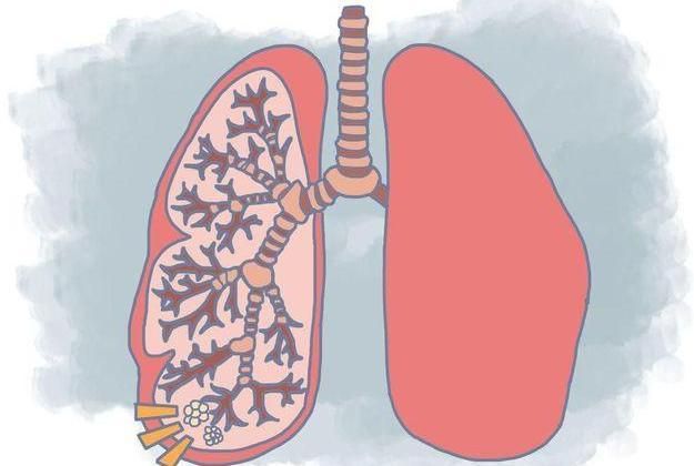 关于肺里有结节是啥意思的信息