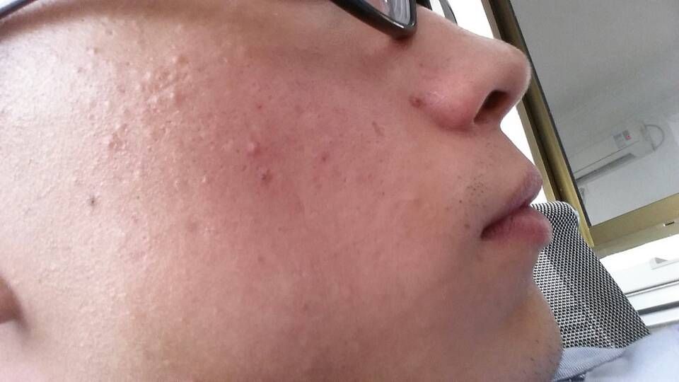 脸上有硬硬的痘痘用什么药物的简单介绍