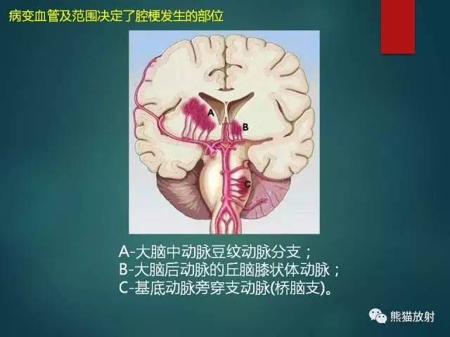 轻脑梗的治疗(急性脑梗一般治疗几天)