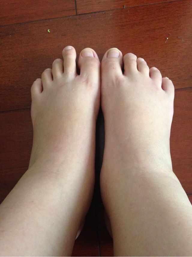 脚肿视频大全的简单介绍