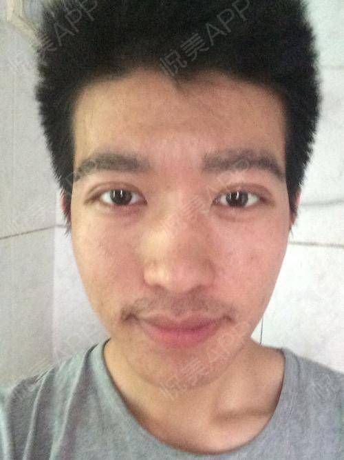 男士肿眼皮(上眼皮无缘无故的肿了)