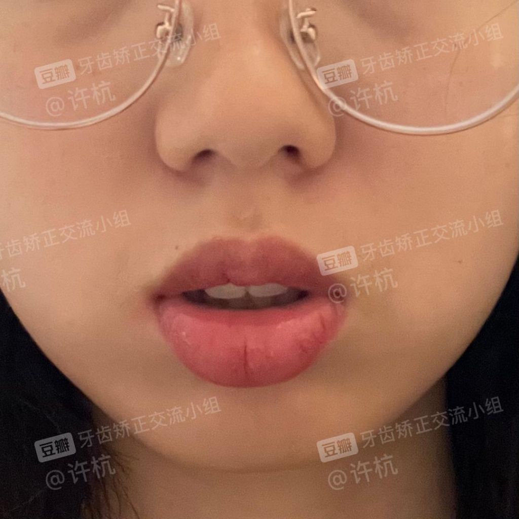 门牙往外凸起图片(门牙牙龈骨头凸起图片)