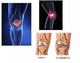 脚脖子骨质增生一走路疼怎么治疗的简单介绍