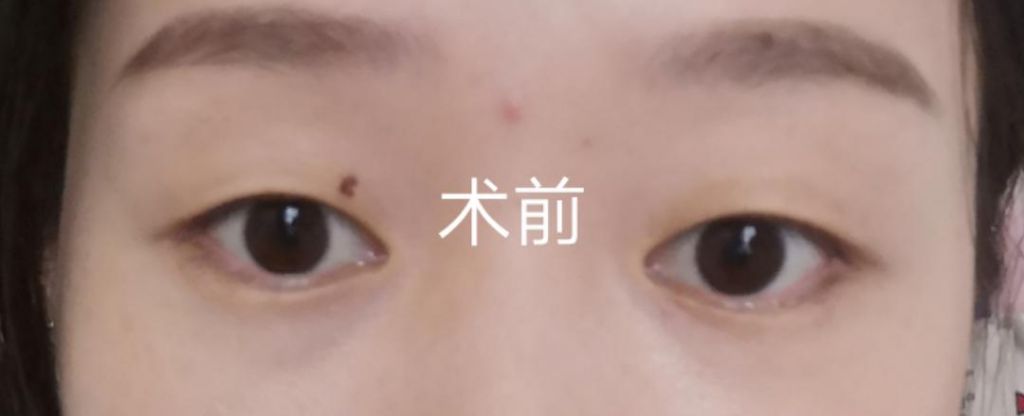 下眼皮在哪里(眼睛下眼睑是哪里)