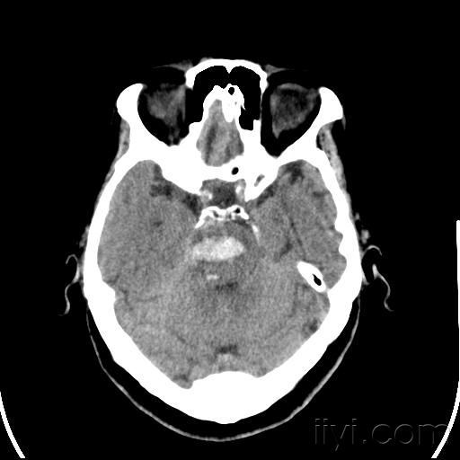 脑出血术后脑干缺血(脑出血后导致脑干缺血怎么办)