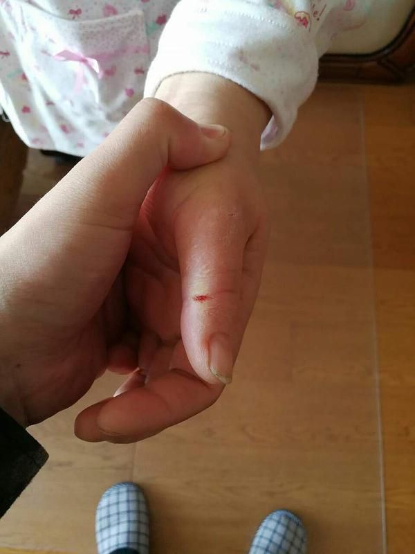 被蜈蚣咬了手很疼要紧吗的简单介绍