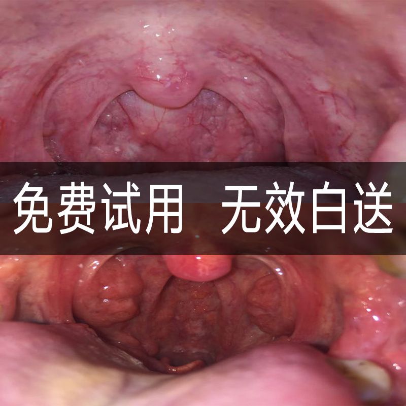 扁桃体有白色东西咳得厉害怎么治的简单介绍
