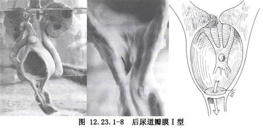 女人尿道在哪里(女性尿道不通畅什么原因)