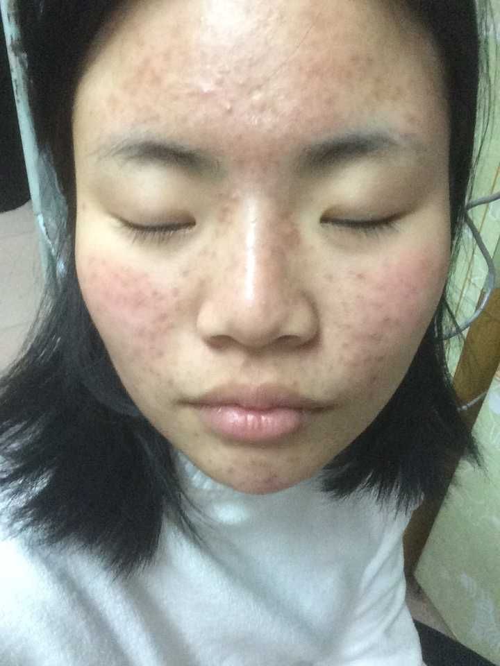 脂溢性皮炎是痘吗(脂溢性皮炎会导致长痘吗)