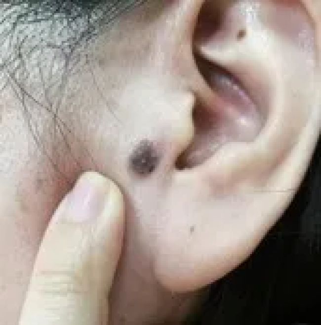 包含为什么痣切除了后留下一个包的词条