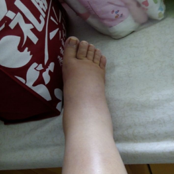 怀孕后期一直脚肿要紧吗(怀孕后期脚肿的厉害怎么缓解)