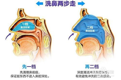 为什么治疗鼻炎这么贵(可见光治疗为什么这么贵)