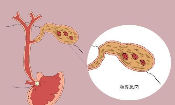 胆囊后壁在哪(胆囊在肝脏的什么位置)