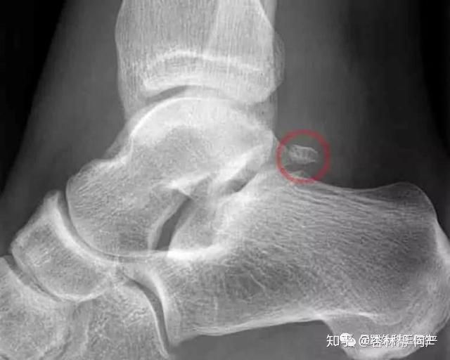 脚踝是什么样的表现(脚踝肿了怎么消肿最快)