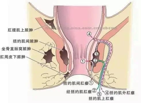肛门粘膜破损瘙痒(肛周裂口瘙痒怎么回事)
