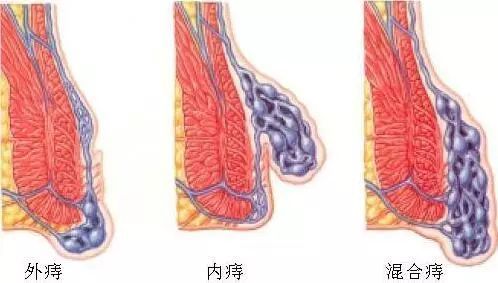 混合痔手术多少时间能好的简单介绍