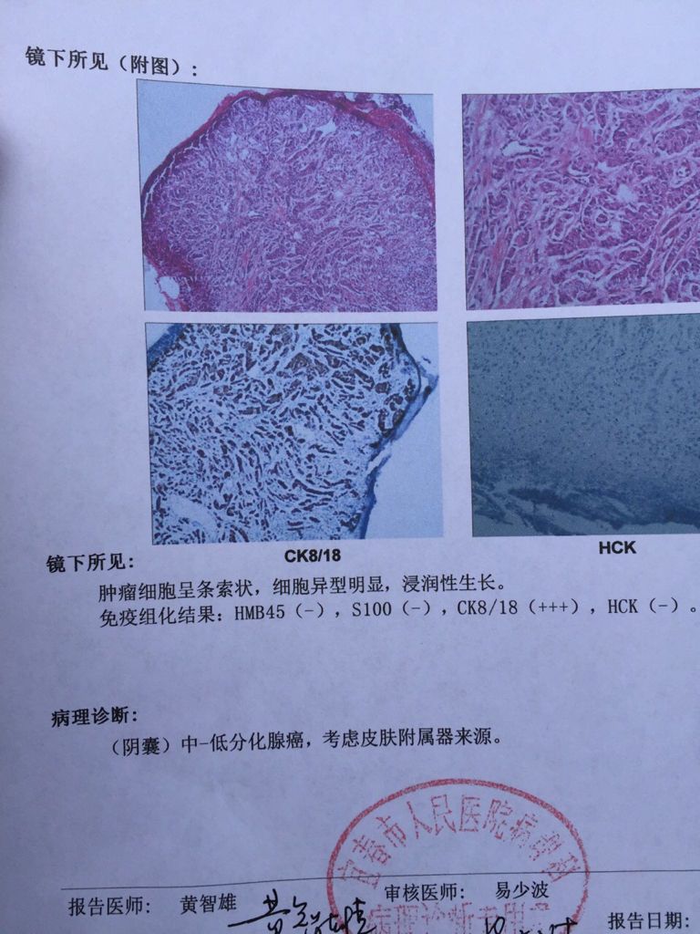 腺癌长在哪(腺癌长在肺上严重吗)