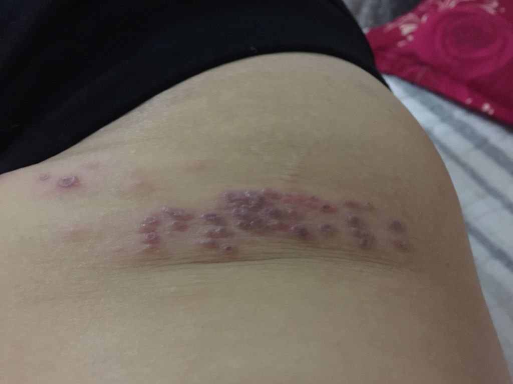 腿上长水疱疹痒(腿上长疱疹需要注意什么)