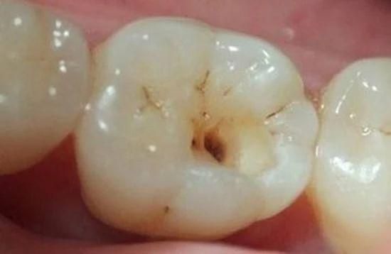 小孩蛀牙不疼怎么办(小孩蛀牙疼怎么办教你立刻止疼)