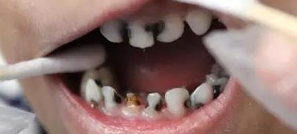 小孩蛀牙不疼怎么办(小孩蛀牙疼怎么办教你立刻止疼)