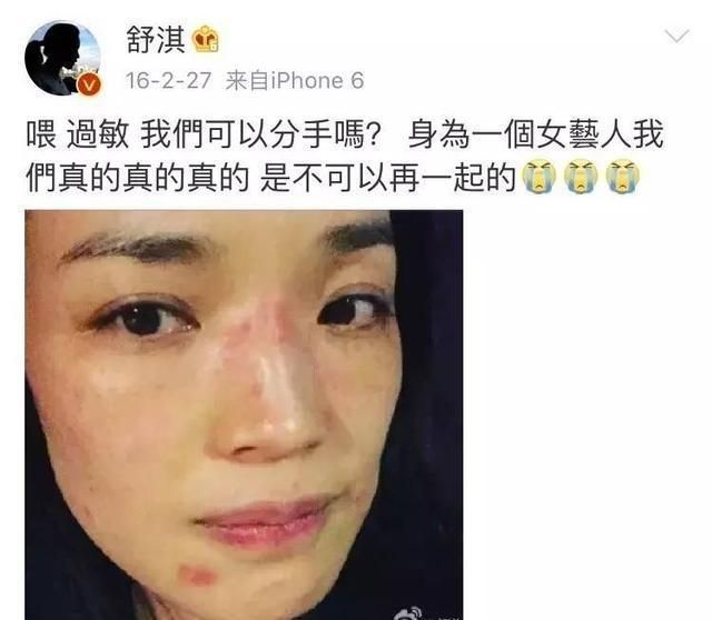 得了荨麻疹会脸红眼睛红吗的简单介绍