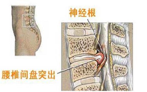 腰椎间盘突出疼痛方法(腰椎间盘突出疼痛吃什么药效果好)