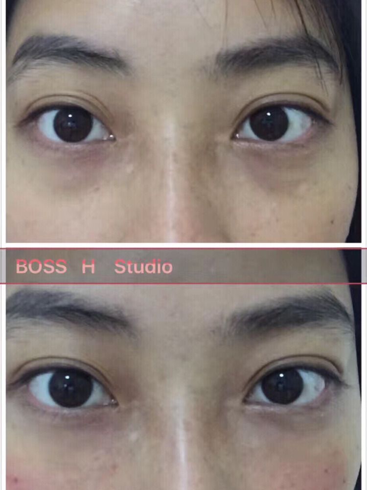 眼睛眼角发黑不是黑眼圈的简单介绍