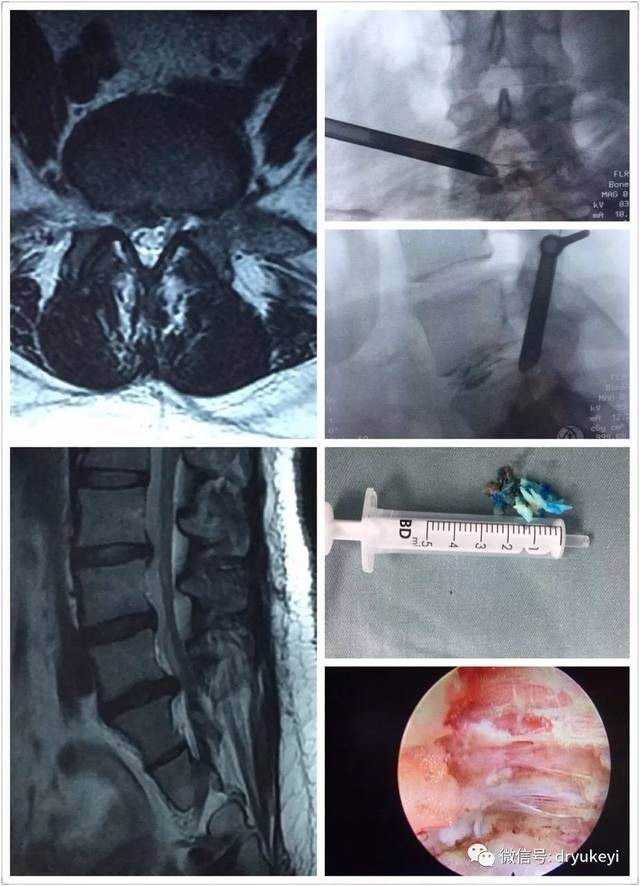 腰椎盘突出压迫到神经怎么治(腰椎盘突出压迫神经腿痛怎么缓解)