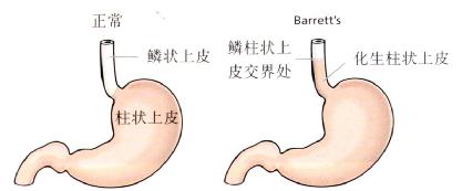 反流性食管炎a级严重的吗(反流性食管炎la一a级严重吗)