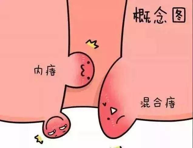 割痔疮大便要清洗吗(痔疮为什么不建议手术)