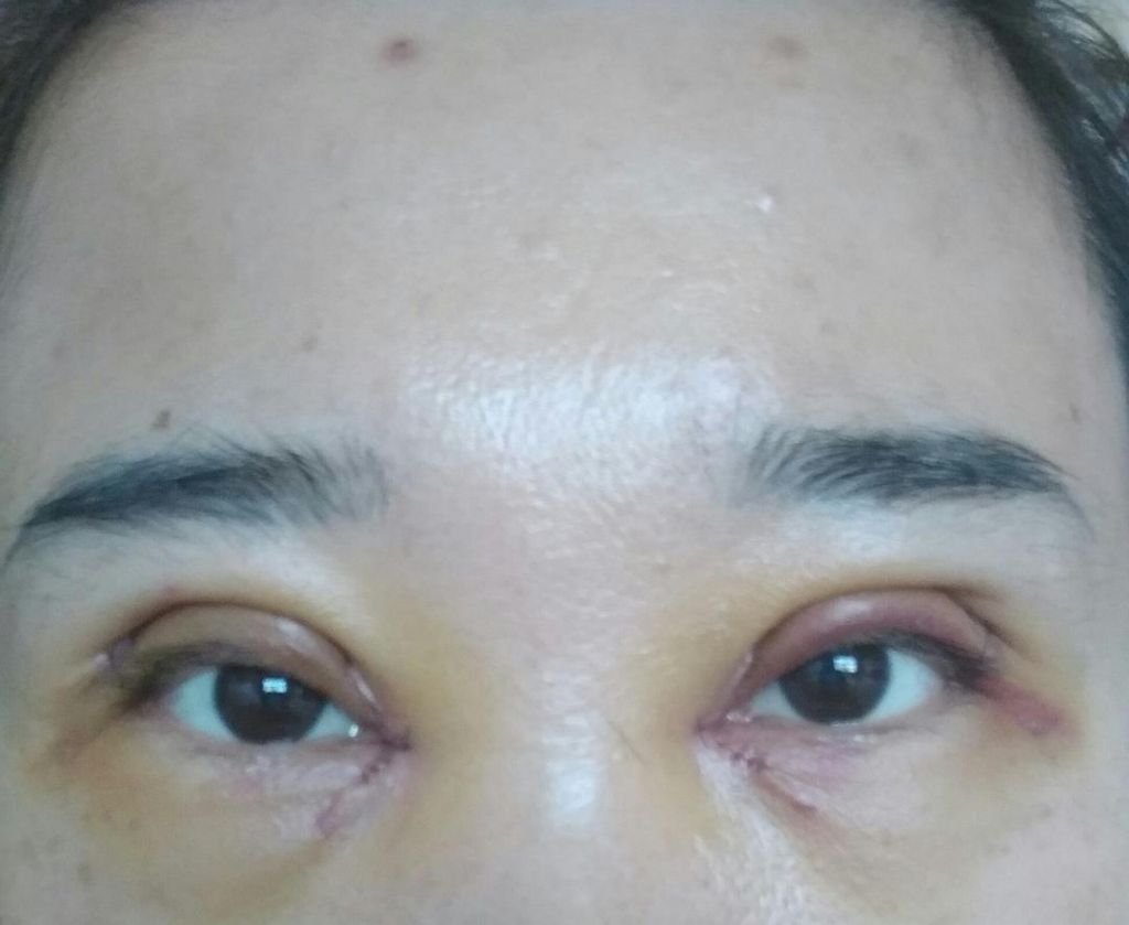 眼睛手术化脓(眼睛化脓了怎么办)