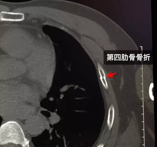 包含肋骨多处骨折40天了还是有点痛的词条