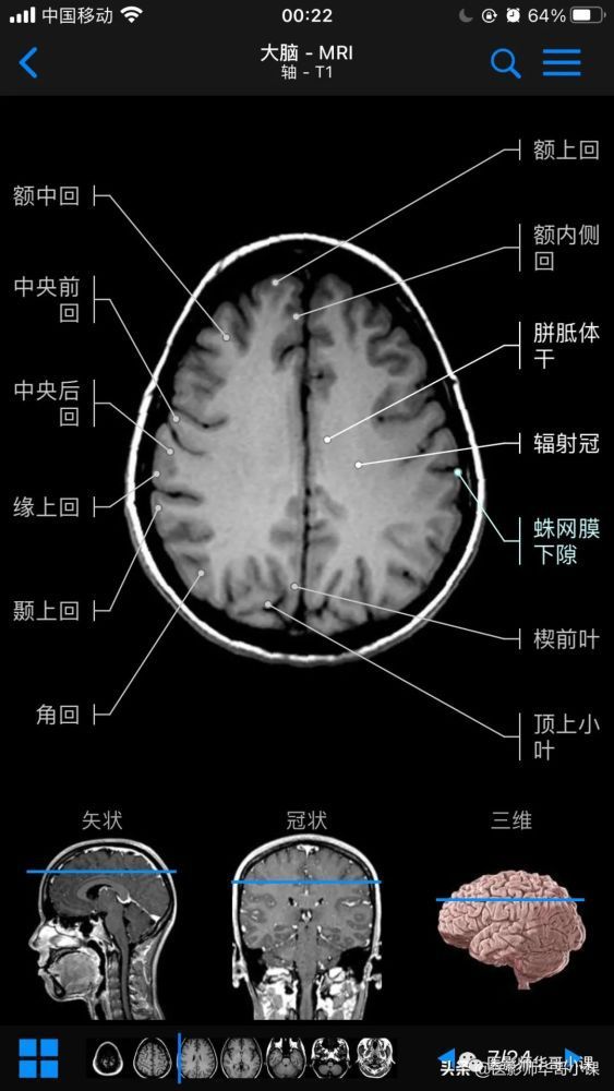 脑颅磁共振的危害(脑颅磁共振多少钱一次)