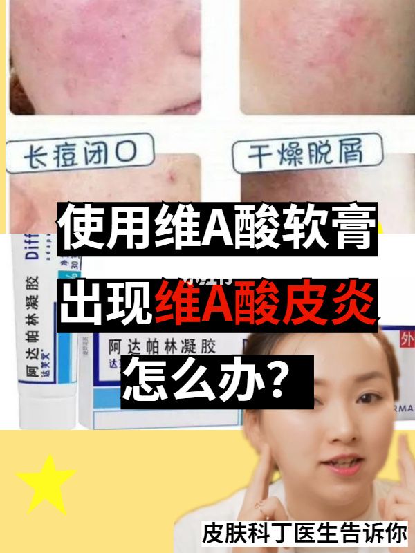 为啥涂维a酸药膏会脱皮的简单介绍
