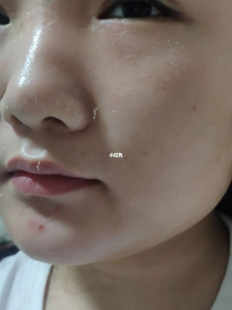 为啥涂维a酸药膏会脱皮的简单介绍