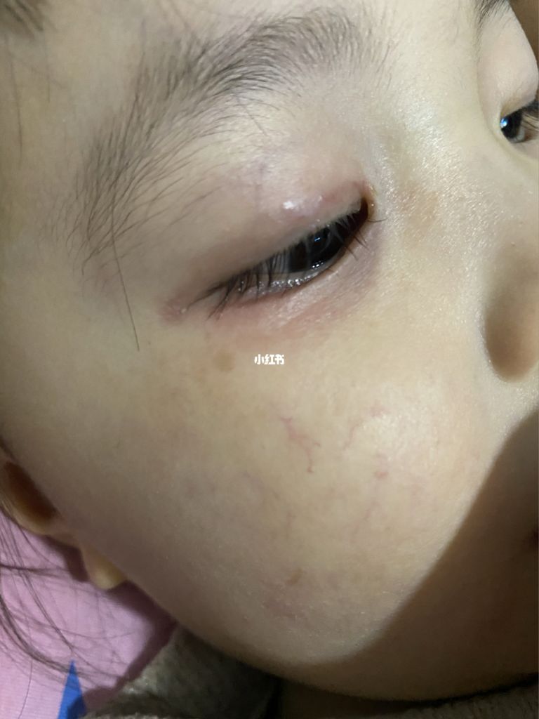 新生儿出生就有眼屎是怎么回事的简单介绍