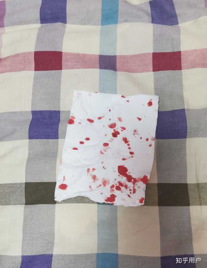家里厕所卫生纸有血(小便后擦拭有血但不疼)