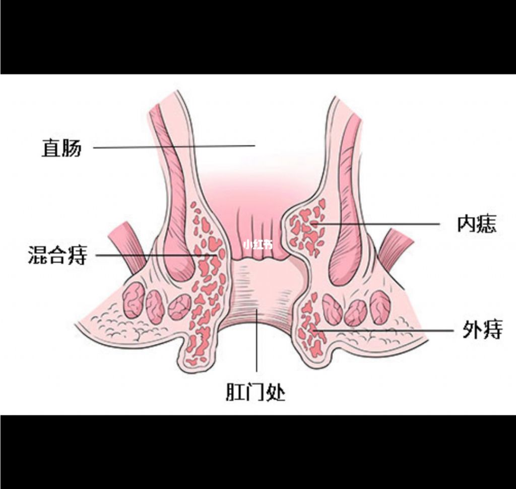 痔疮会长在哪里(长了痔疮有肉坨会消吗)