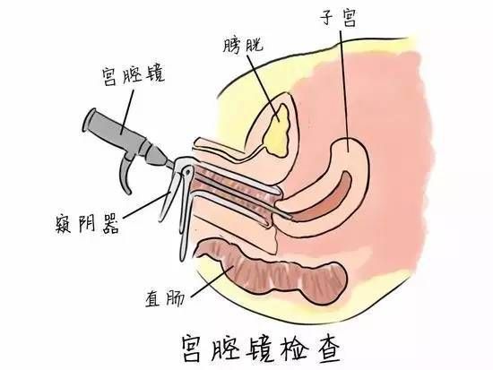 未生育的宫颈口有多粗(正常宫颈口大小标准图片)