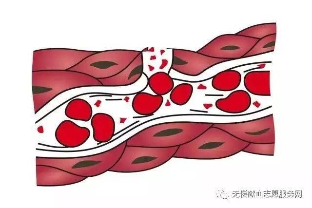 包含血小板低时会影响大血小板比率吗的词条