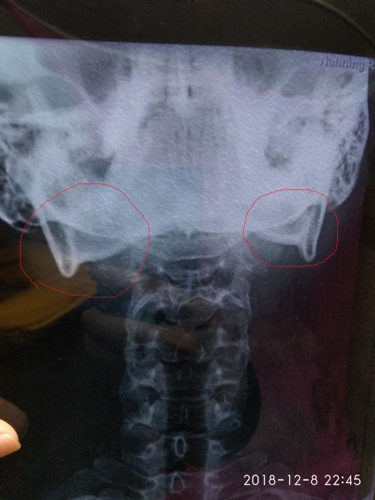 腰椎脱臼会自愈吗的简单介绍