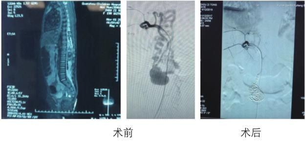 血管瘤脉管畸形病例(脉管畸形和血管瘤的区别)