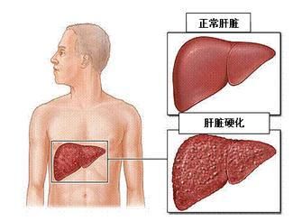 肝癌手术后发热多久可以恢复的简单介绍