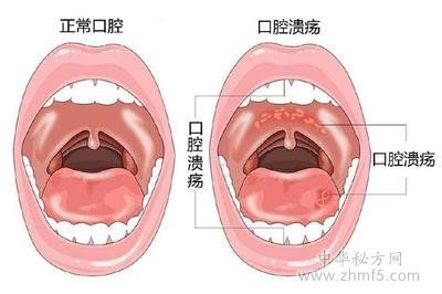 关于口腔咬破了变成溃疡肿了怎么办的信息