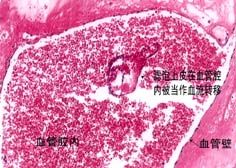 甲状腺滤泡性腺瘤血流丰富的简单介绍